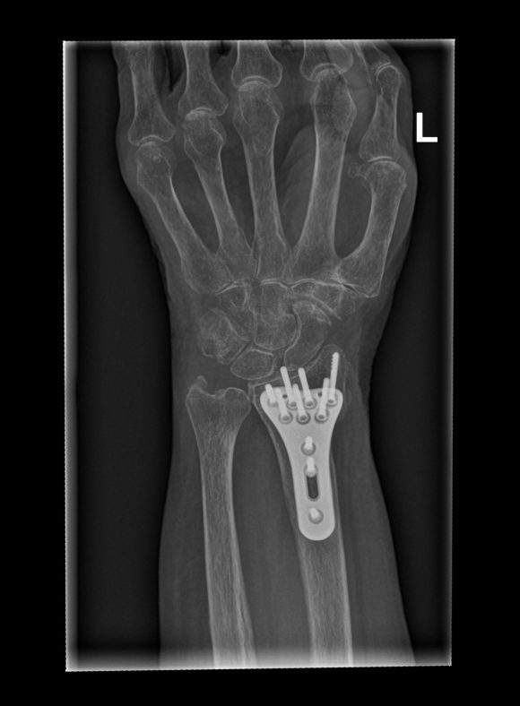 Postoperatieve afbeelding van polsbreuk gefixeerd met plaat en schroeven na osteosynthese