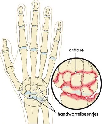 Illustratie van een hand met slijtage aan de pols.