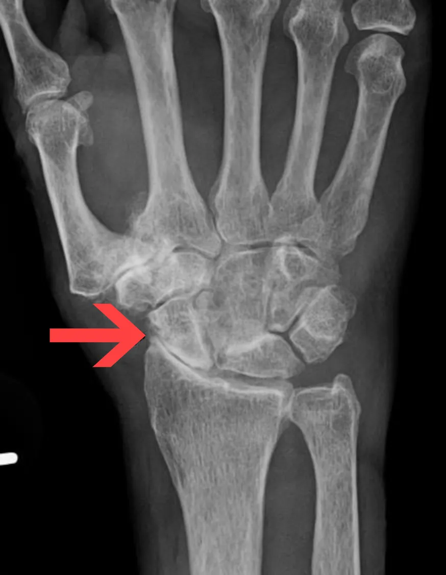 Een RX van een hand met slijtage aan de pols.