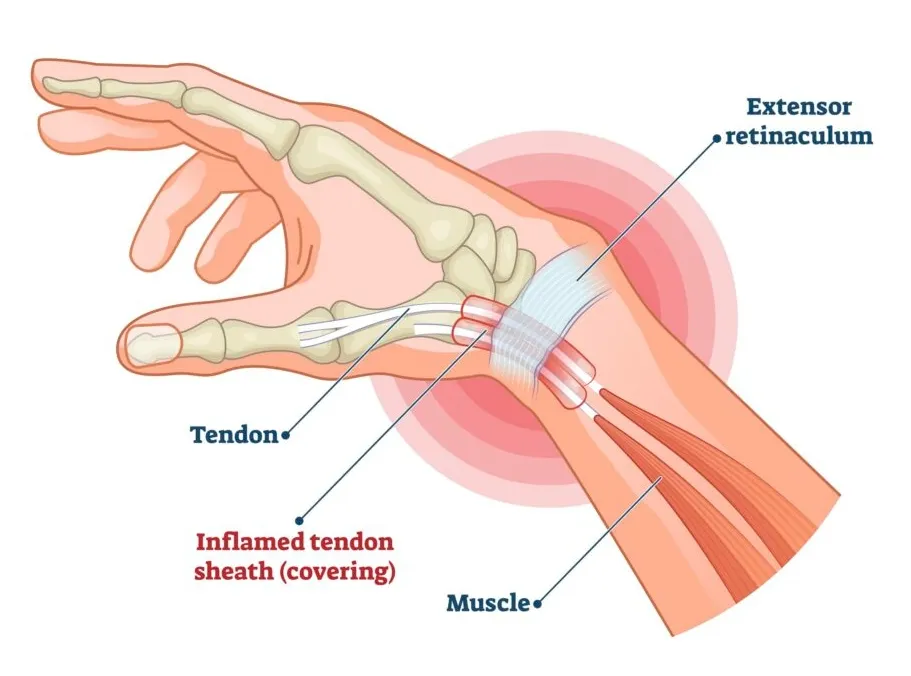 De Quervain tendinitis: ontstoken peesschede aan de duimzijde van de pols
