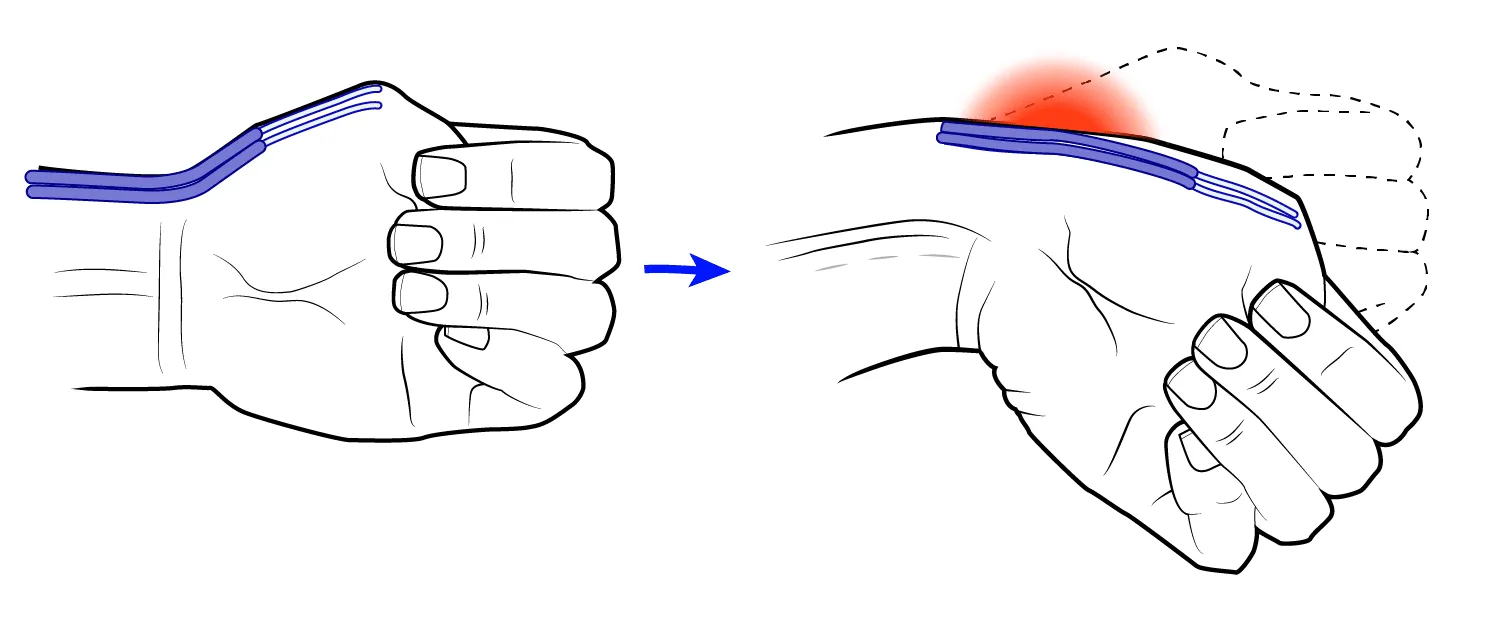 Test van Finkelstein om de Quervain tendinitis aan de duimzijde van de pols op te sporen