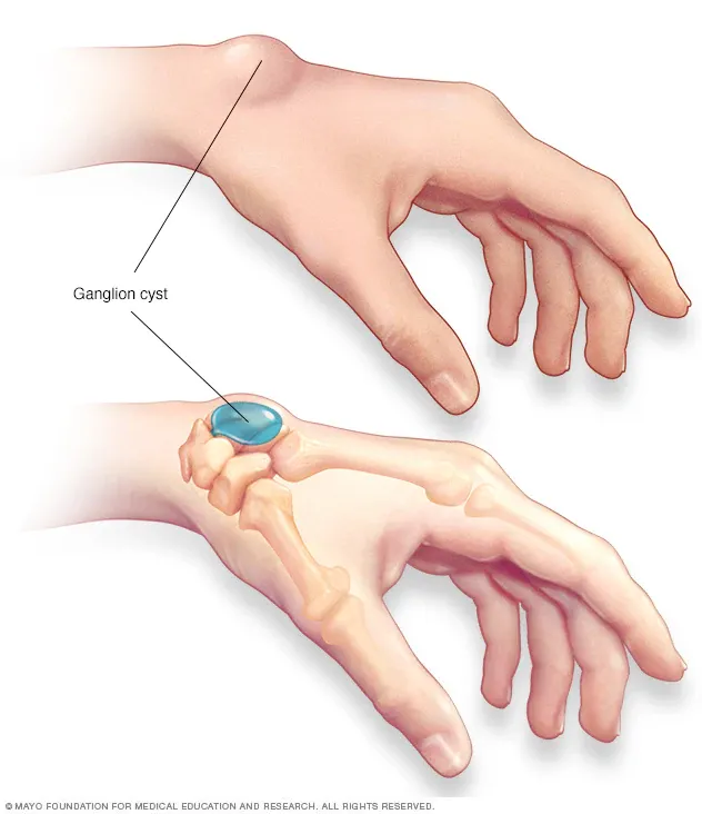 Ganglion of polscyste aan de pols