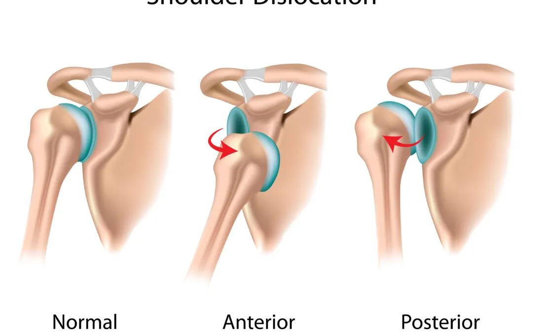 Schouder uit de kom: luxatie op rontgenbeeld - Orthopedie Turnhout.