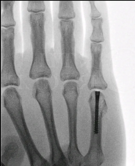 Vingerbreuk gefixeerd met schroef na operatieve behandeling van een instabiele fractuur
