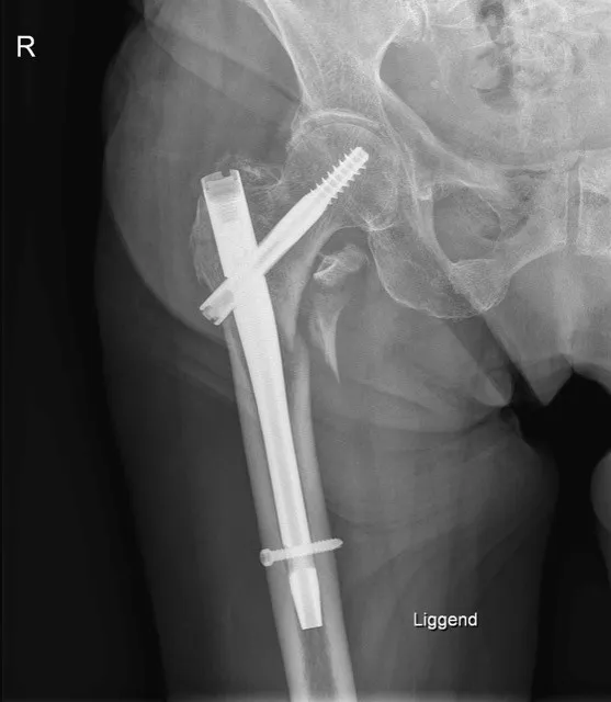 Heupfractuur: fixatie met mergpen op rontgenbeeld - Orthopedie Turnhout.
