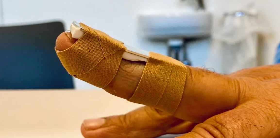 Mallet spalk voor immobilisatie van de strekpees bij mallet vinger als conservatieve behandeling