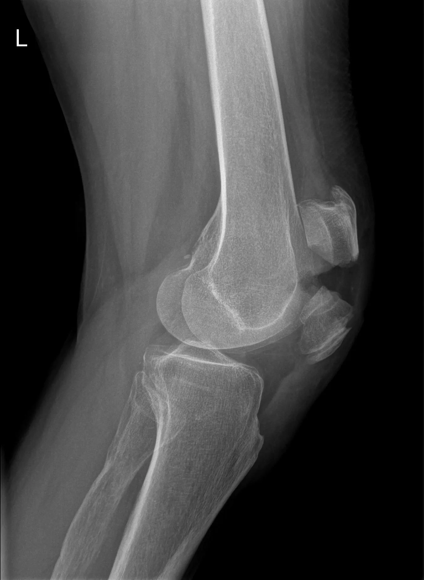 Gebroken knieschijf: medisch beeld bij Orthopedie Turnhout.