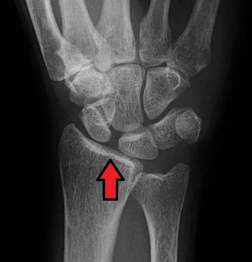 Röntgenfoto van scapholunaire ligamentruptuur met verbrede ruimte tussen scaphoid en lunatum