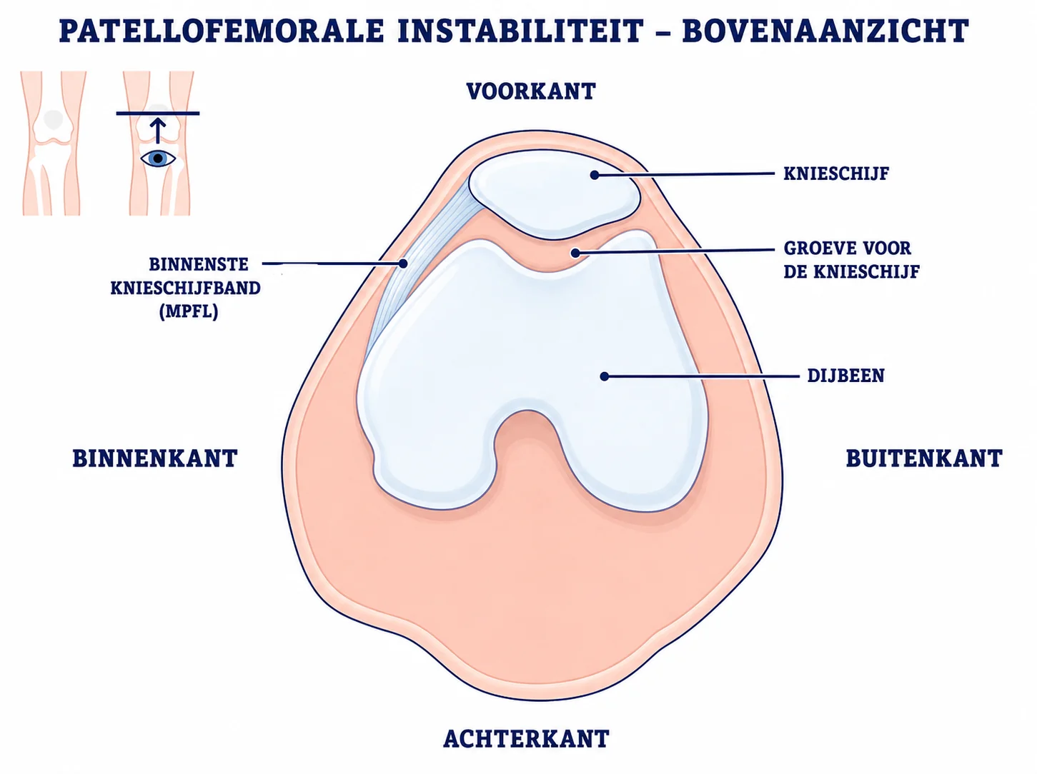 Axiale vergelijking van een stabiele en naar buiten verschoven knieschijf
